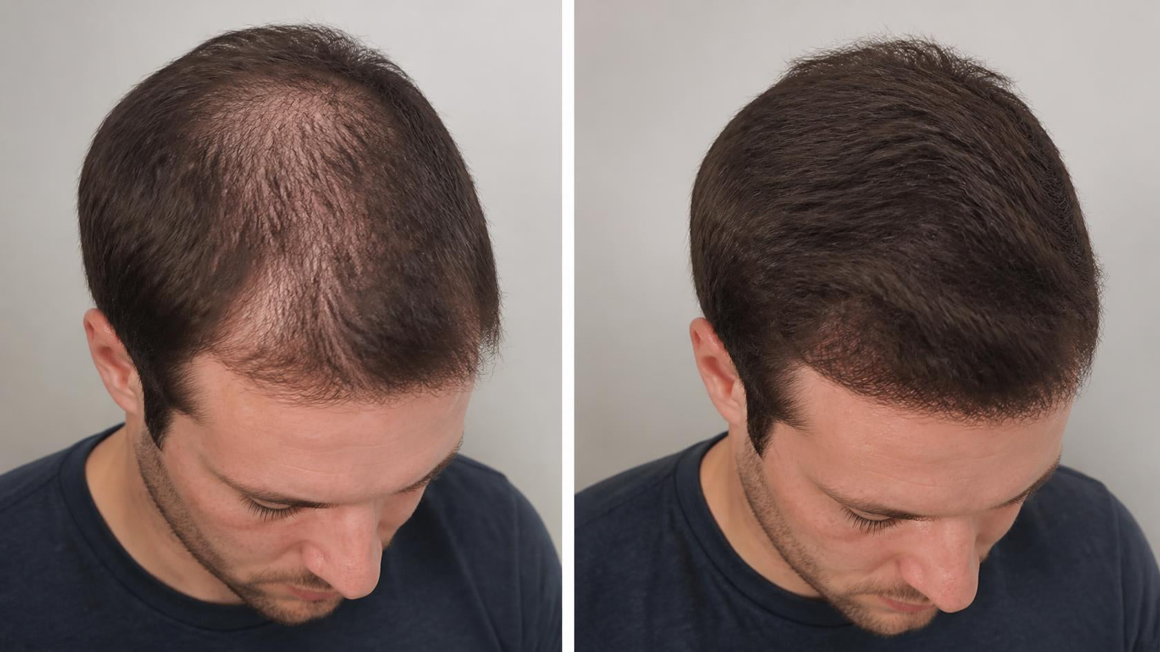 Hair growth & strengthening with infusio technology